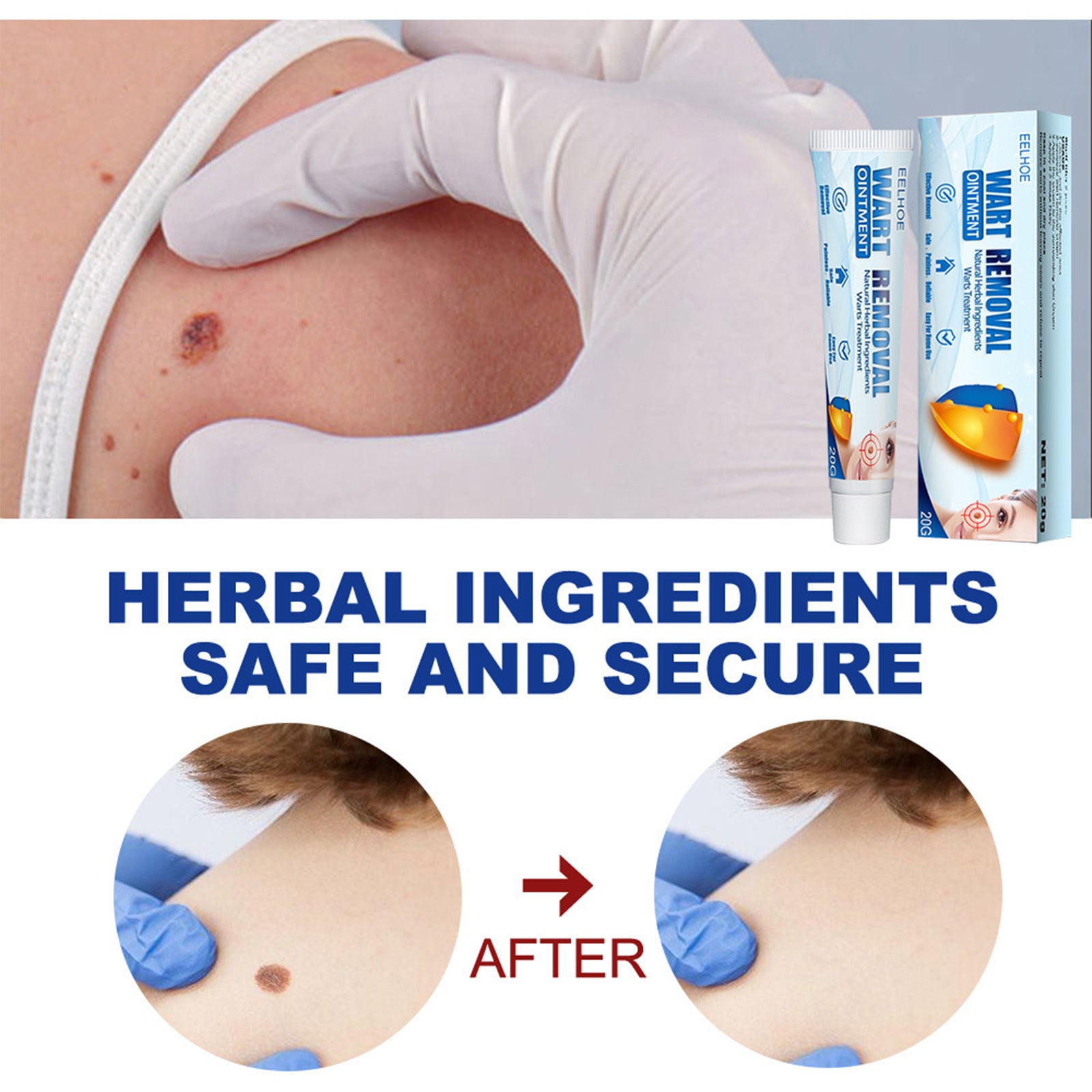 Skin Tag & Wart Removal Cream – Repairing Facial Skin Treatment